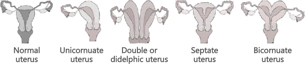 Deformities of the uterus