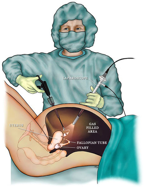 Laparoscopic procedure